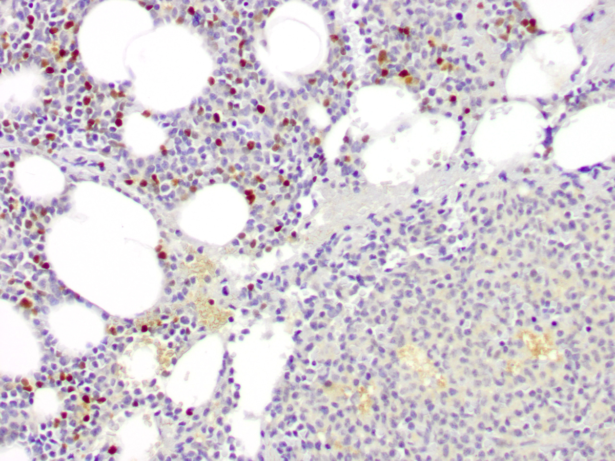 A subset of the blasts expresses Pax-5, while the plasmacytoid dendritic cells are negative